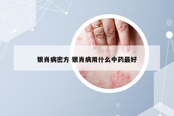 银肖病密方 银肖病用什么中药最好