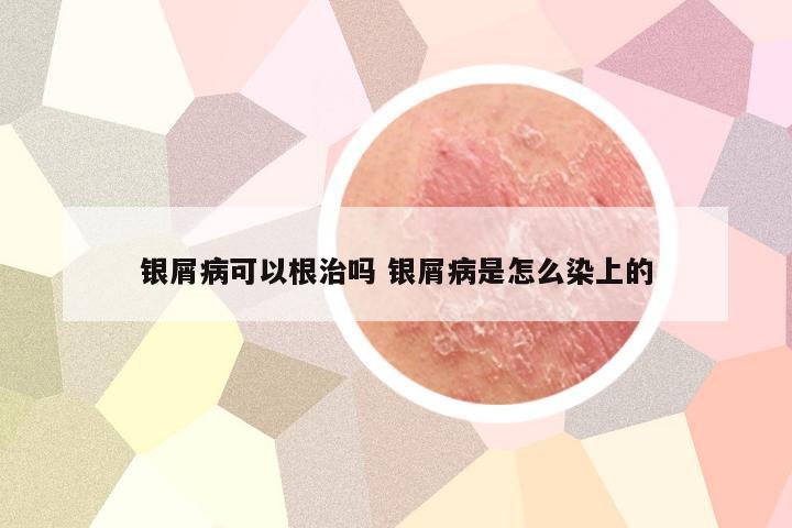 银屑病可以根治吗 银屑病是怎么染上的