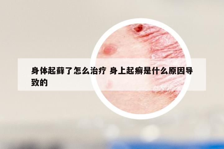 身体起藓了怎么治疗 身上起癣是什么原因导致的