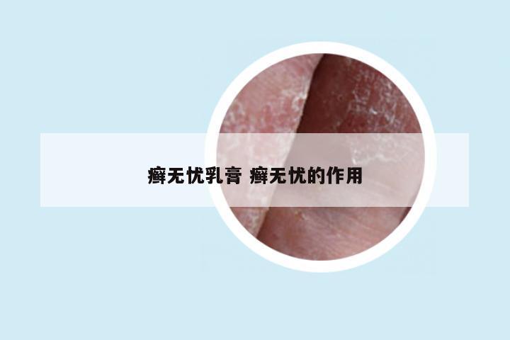 癣无忧乳膏 癣无忧的作用