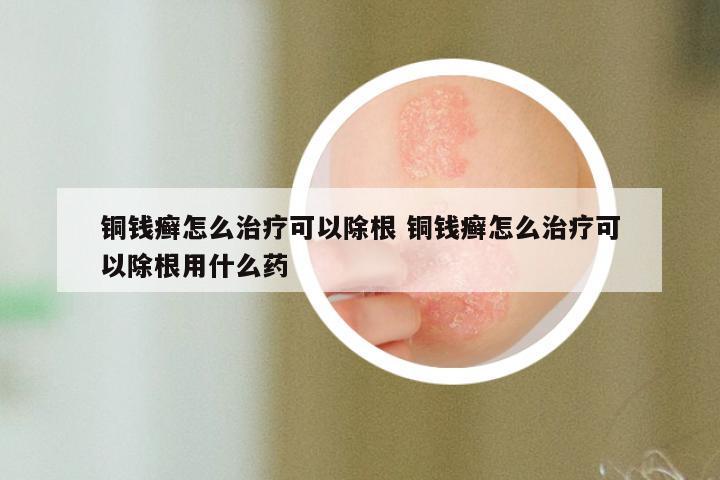 铜钱癣怎么治疗可以除根 铜钱癣怎么治疗可以除根用什么药