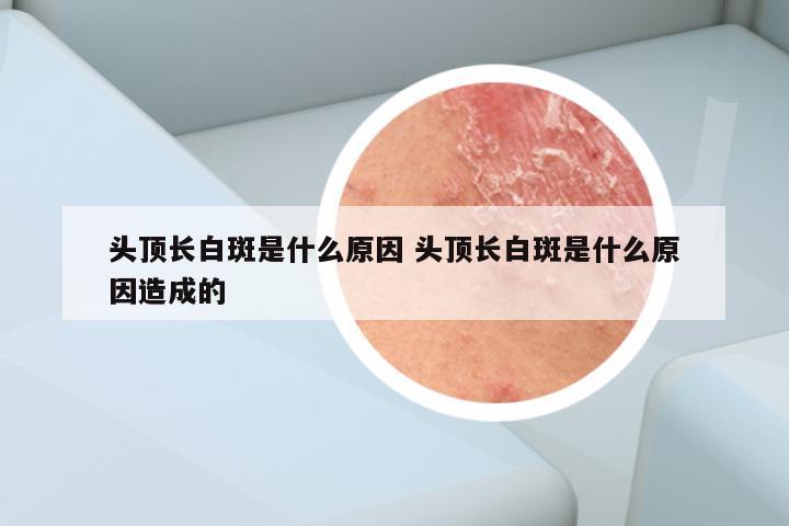 头顶长白斑是什么原因 头顶长白斑是什么原因造成的