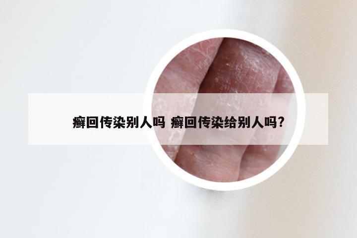 癣回传染别人吗 癣回传染给别人吗?