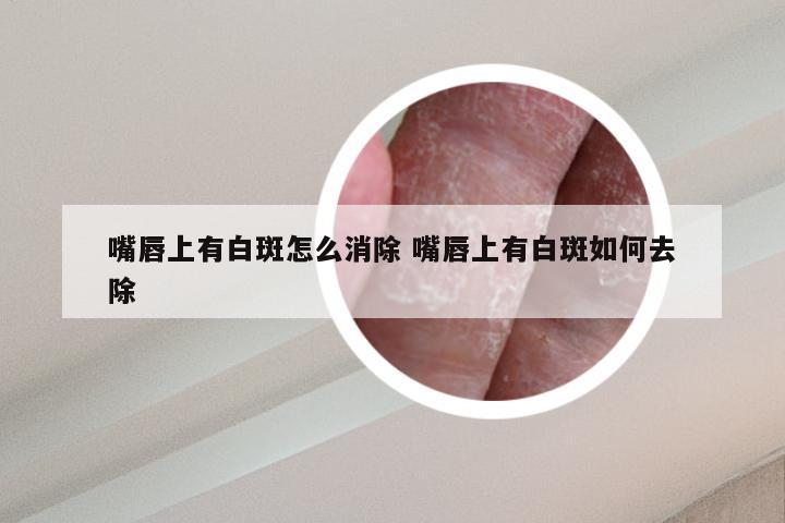 嘴唇上有白斑怎么消除 嘴唇上有白斑如何去除