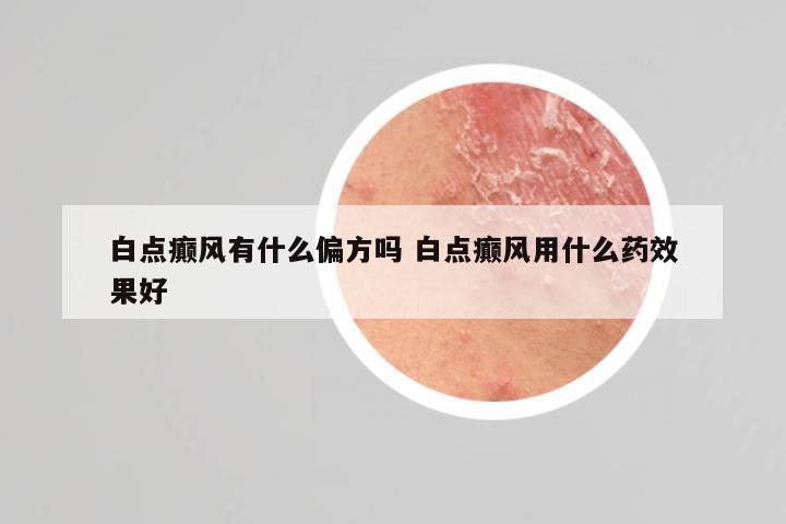 白点癫风有什么偏方吗 白点癫风用什么药效果好