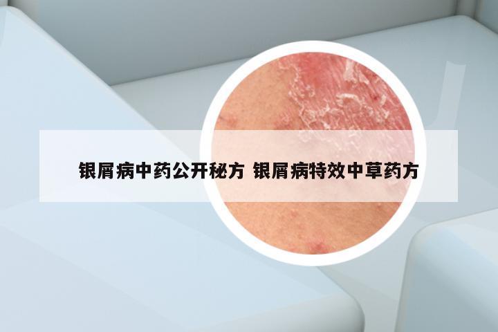 银屑病中药公开秘方 银屑病特效中草药方