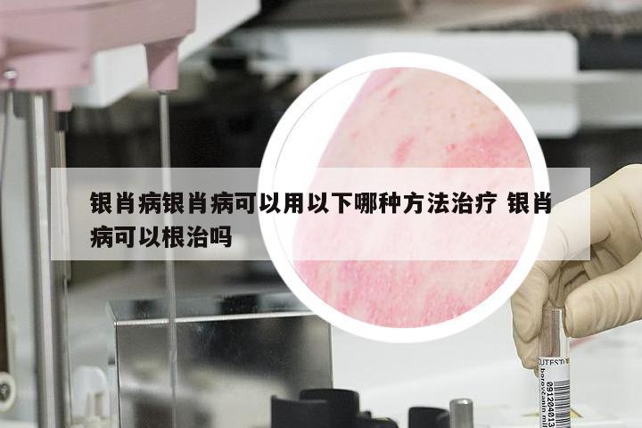 银肖病银肖病可以用以下哪种方法治疗 银肖病可以根治吗