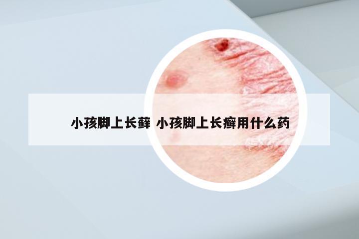 小孩脚上长藓 小孩脚上长癣用什么药