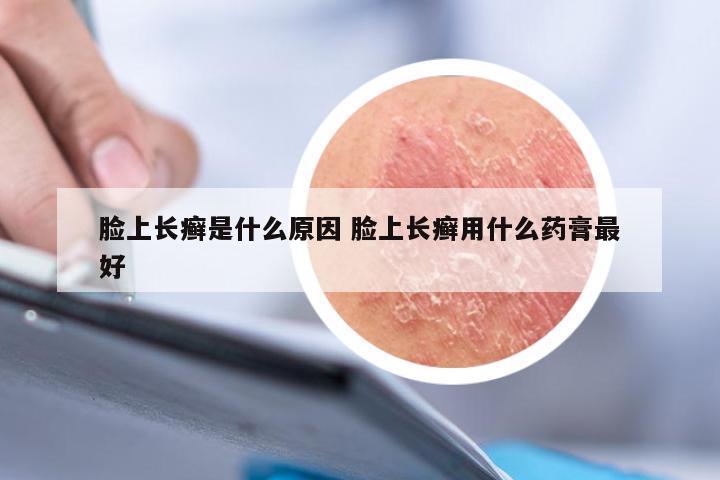 脸上长癣是什么原因 脸上长癣用什么药膏最好