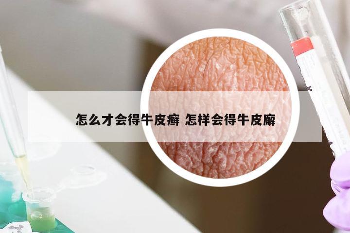 怎么才会得牛皮癣 怎样会得牛皮廨