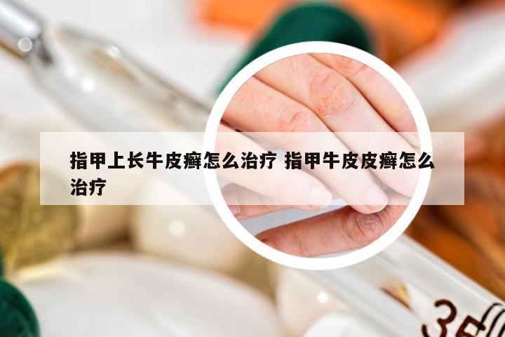 指甲上长牛皮癣怎么治疗 指甲牛皮皮癣怎么治疗