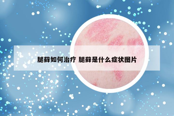 腿藓如何治疗 腿藓是什么症状图片