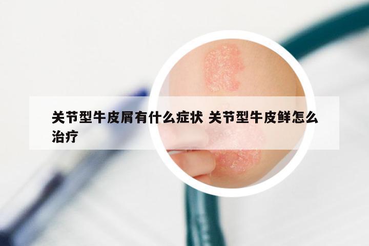 关节型牛皮屑有什么症状 关节型牛皮鲜怎么治疗