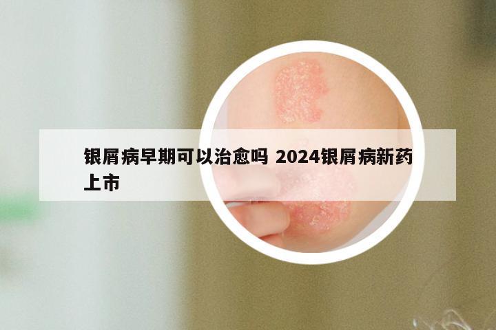 银屑病早期可以治愈吗 2024银屑病新药上市