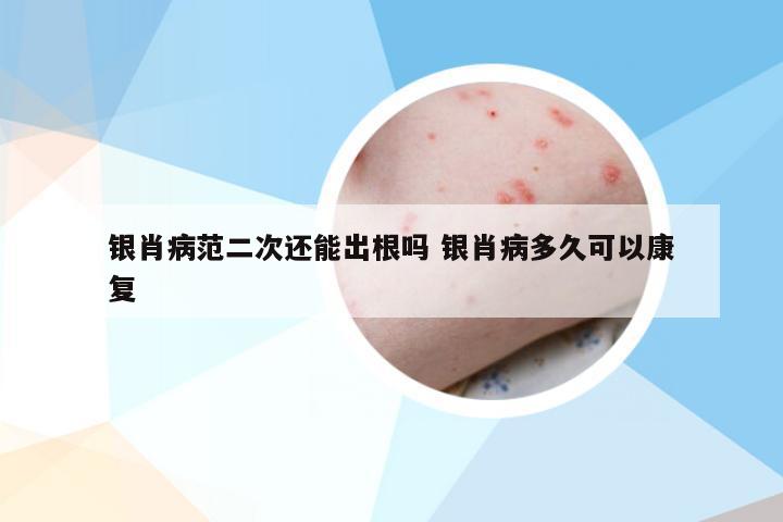 银肖病范二次还能出根吗 银肖病多久可以康复