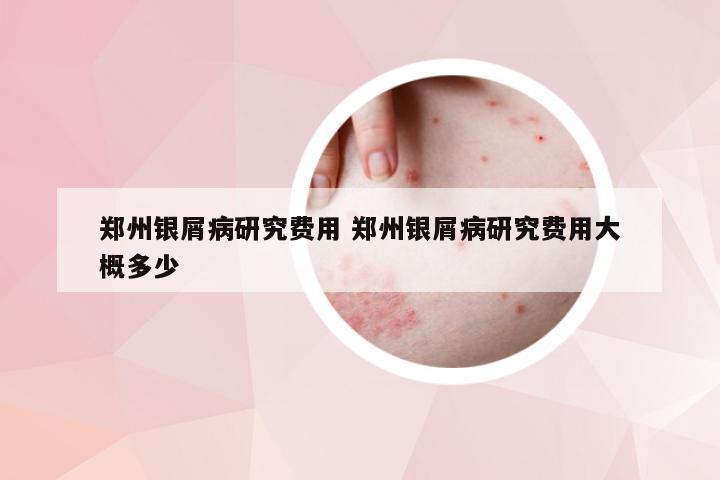 郑州银屑病研究费用 郑州银屑病研究费用大概多少