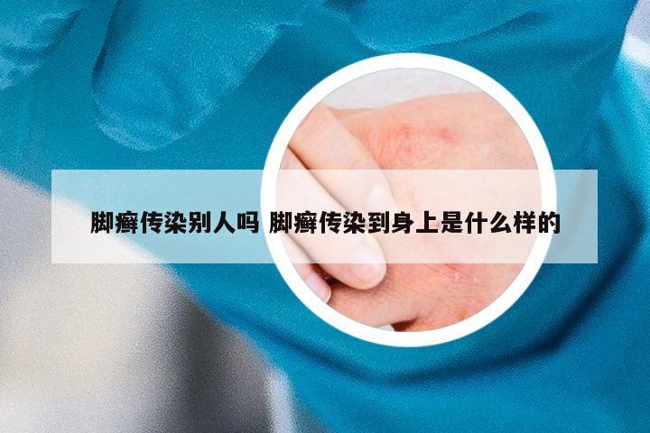 脚癣传染别人吗 脚癣传染到身上是什么样的