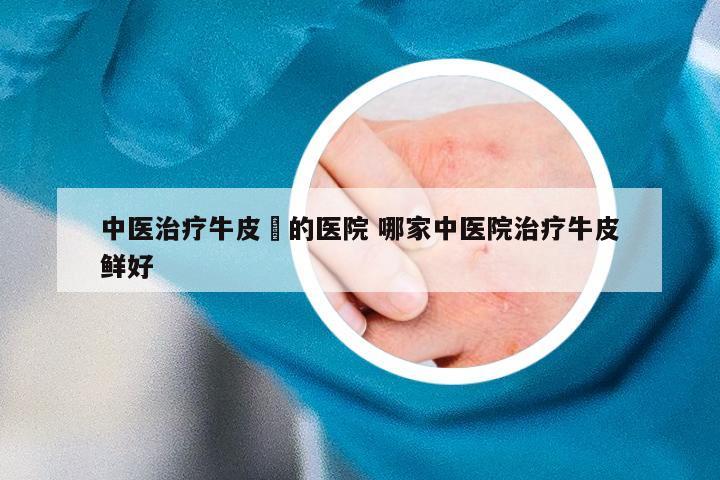 中医治疗牛皮廯的医院 哪家中医院治疗牛皮鲜好