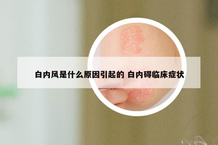 白内风是什么原因引起的 白内碍临床症状