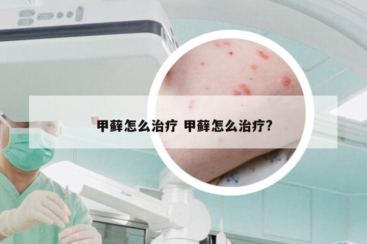 甲藓怎么治疗 甲藓怎么治疗?