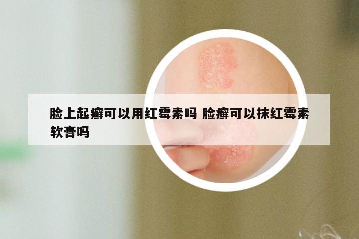 脸上起癣可以用红霉素吗 脸癣可以抹红霉素软膏吗