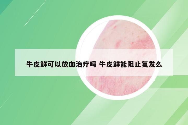 牛皮鲜可以放血治疗吗 牛皮鲜能阻止复发么