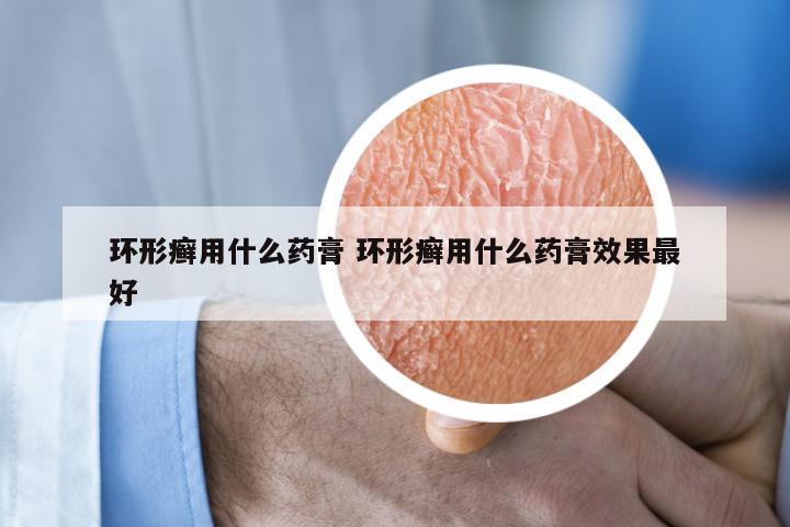 环形癣用什么药膏 环形癣用什么药膏效果最好