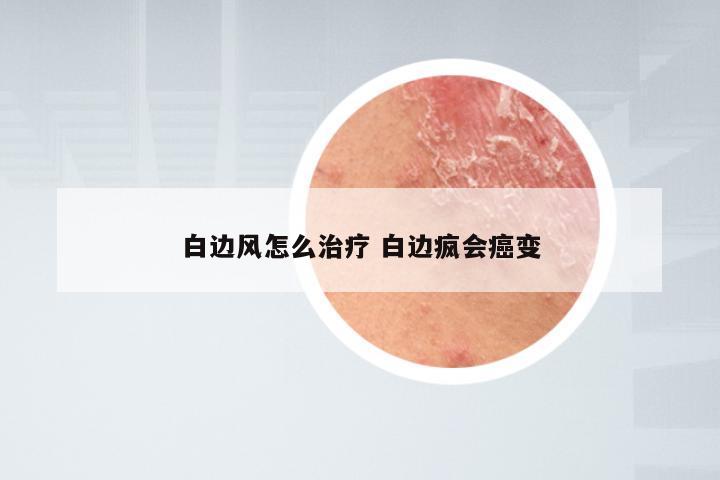 白边风怎么治疗 白边疯会癌变