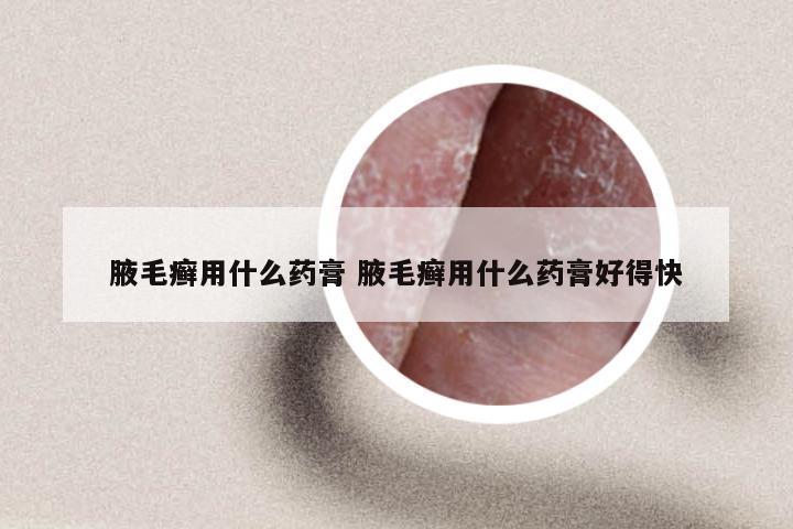 腋毛癣用什么药膏 腋毛癣用什么药膏好得快