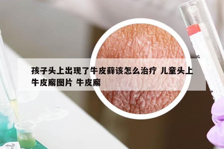 孩子头上出现了牛皮藓该怎么治疗 儿童头上牛皮廨图片 牛皮廨