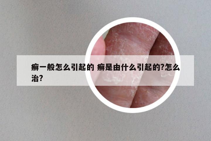 癣一般怎么引起的 癣是由什么引起的?怎么治?