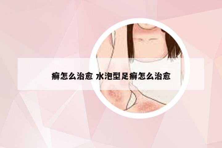 癣怎么治愈 水泡型足癣怎么治愈