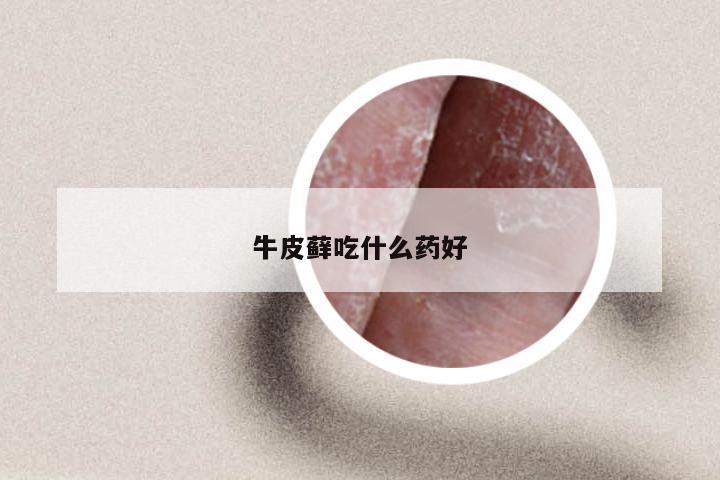 牛皮藓吃什么药好