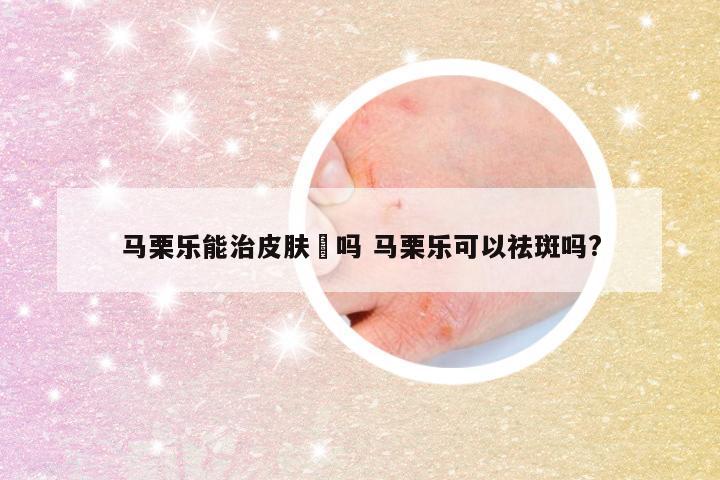 马栗乐能治皮肤廯吗 马栗乐可以祛斑吗?