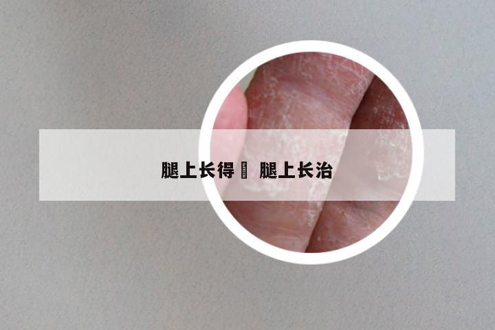 腿上长得廯 腿上长治