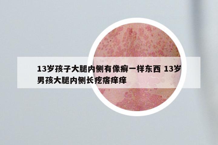 13岁孩子大腿内侧有像癣一样东西 13岁男孩大腿内侧长疙瘩痒痒