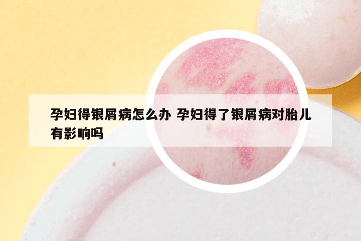 孕妇得银屑病怎么办 孕妇得了银屑病对胎儿有影响吗