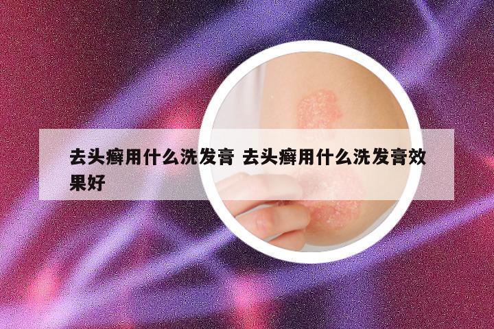 去头癣用什么洗发膏 去头癣用什么洗发膏效果好