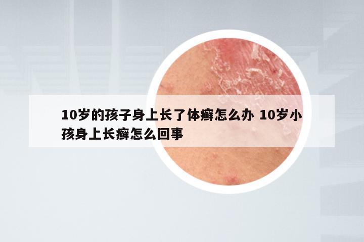 10岁的孩子身上长了体癣怎么办 10岁小孩身上长癣怎么回事