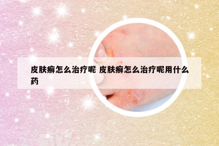 皮肤癣怎么治疗呢 皮肤癣怎么治疗呢用什么药