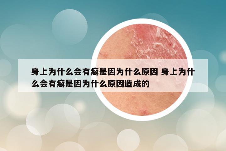 身上为什么会有癣是因为什么原因 身上为什么会有癣是因为什么原因造成的