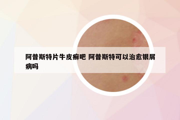 阿普斯特片牛皮癣吧 阿普斯特可以治愈银屑病吗