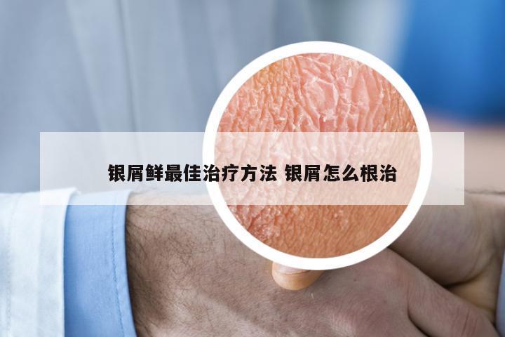 银屑鲜最佳治疗方法 银屑怎么根治