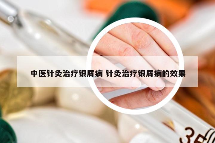 中医针灸治疗银屑病 针灸治疗银屑病的效果