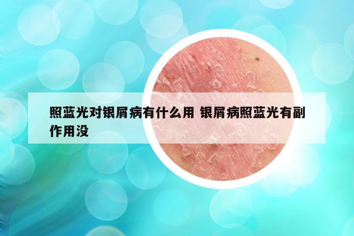 照蓝光对银屑病有什么用 银屑病照蓝光有副作用没