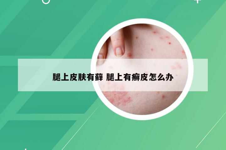 腿上皮肤有藓 腿上有癣皮怎么办