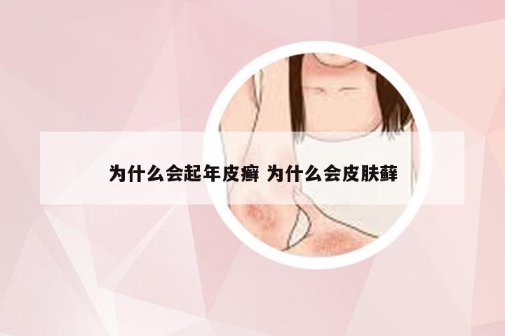 为什么会起年皮癣 为什么会皮肤藓