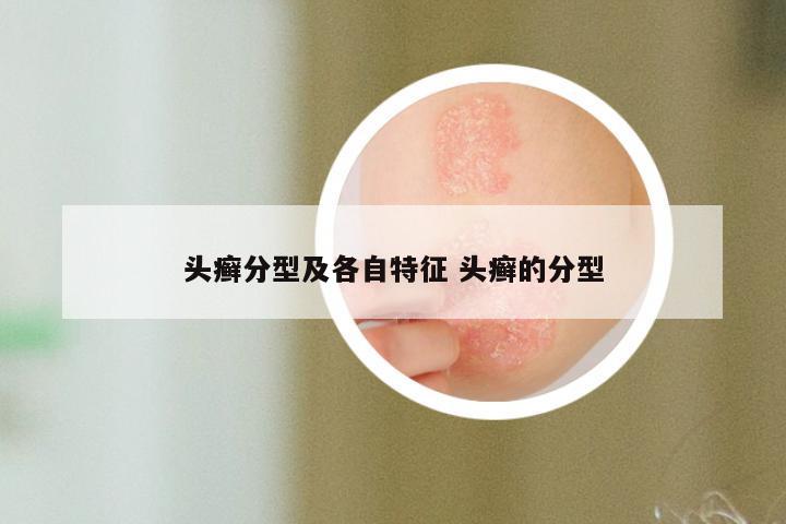 头癣分型及各自特征 头癣的分型