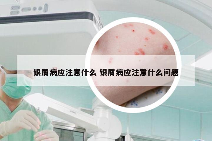 银屑病应注意什么 银屑病应注意什么问题