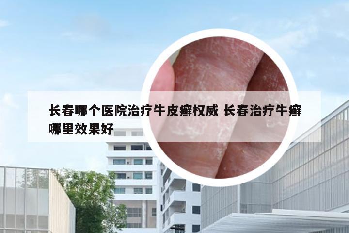 长春哪个医院治疗牛皮癣权威 长春治疗牛癣哪里效果好